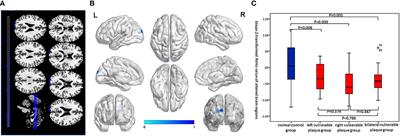 Brain alterations of regional homogeneity, degree centrality, and functional connectivity in vulnerable carotid plaque patients with neither clinical symptoms nor routine MRI lesions: A resting-state fMRI study